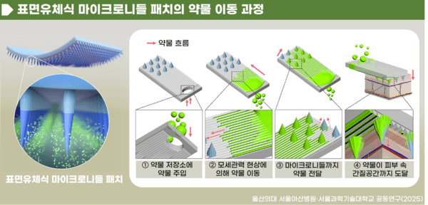 표면유체식 마이크로니들 패치의 약물 이동 과정 [출처=서울아산병원]