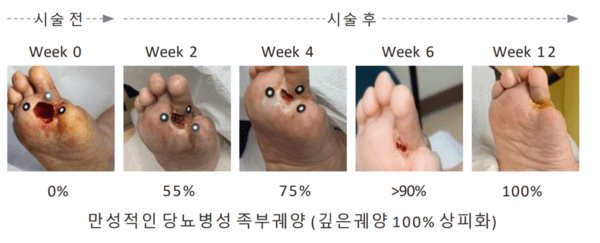 로킷헬스케어가 한국보건의료연구원으로부터 당뇨발 AI 재생치료에 대한 임상시험 시작 승인을 획득했다.[출처=로킷헬스케어]